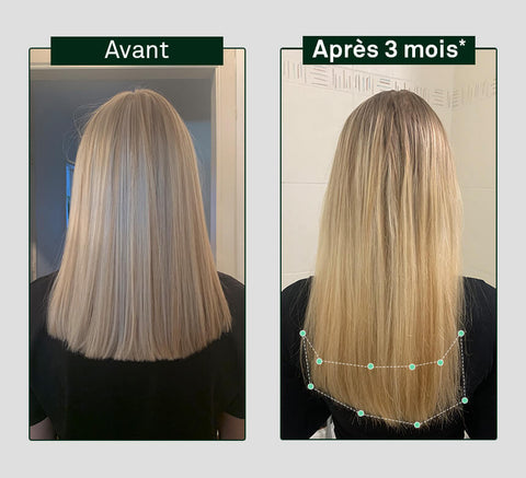 Pirms un pēc matu augšanas salīdzinājums uz cilvēka galvas, parādot redzamu atšķirību pēc 3 mēnešiem.