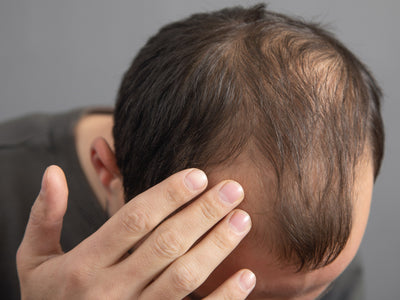 Hair Loss